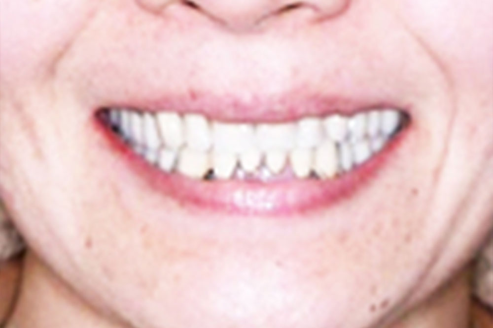 ほとんど歯がない人の部分入れ歯 4０代女性 入れ歯専門の歯科医院 東京池袋の萩原歯科医院